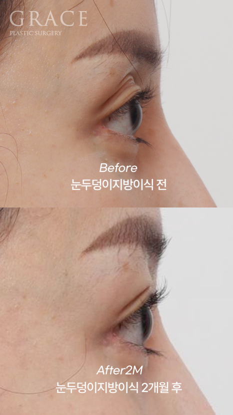 Eyebrow Fat Grafting &middot; Eyelid Fat Grafting &middot; Sunken Eyes Surgery Cost Information (As of June 2025) image 14