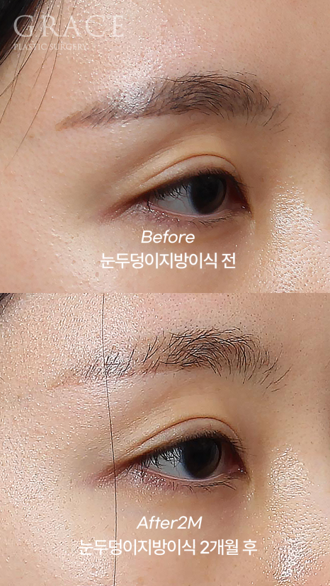Upper Eyelid Fat Grafting That Shows When You Close Your Eyes? The Cause of Side Effects Is Different image 5
