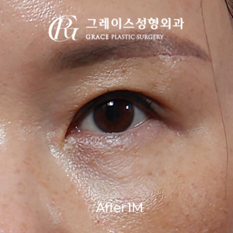 A Complete Guide to the Best Combination of Midlife Eye Surgery, from Under-Eye Fat Repositioning Costs to an I-Hole Filler Alternative image 2