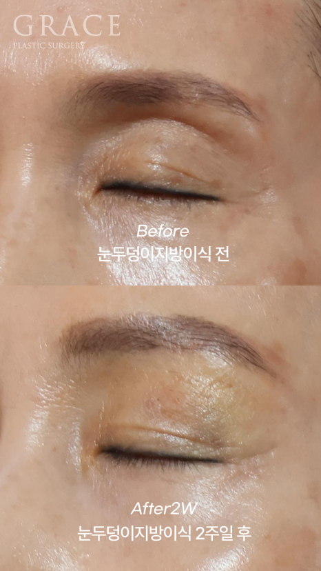 60대 중년 눈두덩이 안와지방이식 1cc 전후 관련 이미지 7