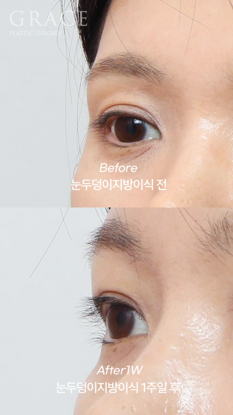 눈두덩이 지방이식 가격보다는 주입방식 관련 이미지 5