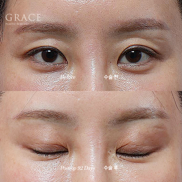 Will a Sunken Upper Eyelid Become Bumpy When You Close Your Eyes After Fat Grafting? image 12