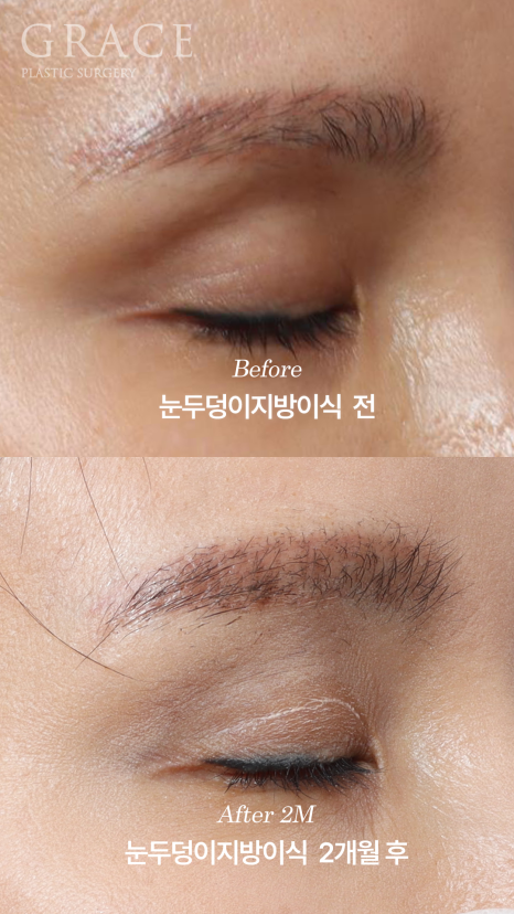 Will Swelling After Eyelid Fat Grafting Last a Long Time... Is It Really True? image 6