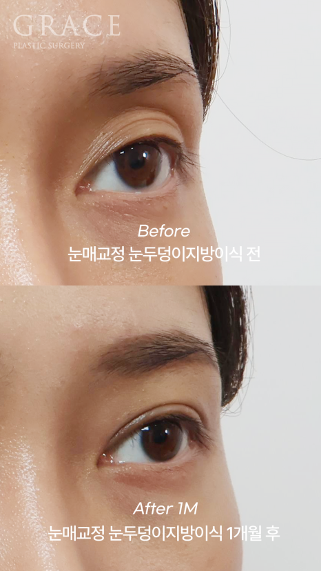 겹쌍꺼풀&middot;비대칭 눈 교정｜패인눈 함몰은 눈꺼풀 지방이식 관련 이미지 5