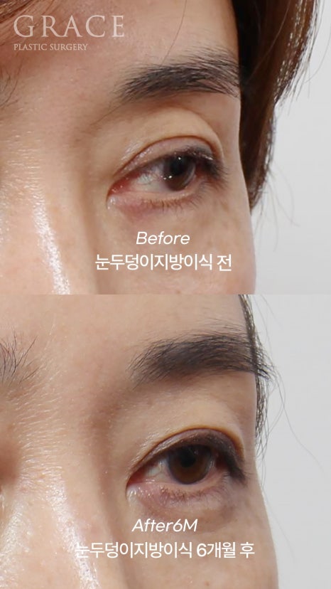 Eyebrow Hollow Fat Grafting Before and After Comparison – Gently Filling Sunken Eyes image 9