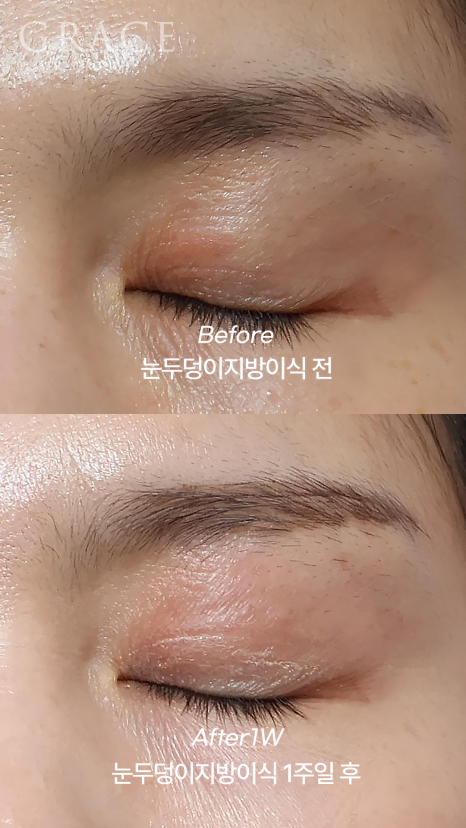 안와지방이식 꺼진 눈매를 되살리는 아이홀 꺼짐 솔루션 관련 이미지 4