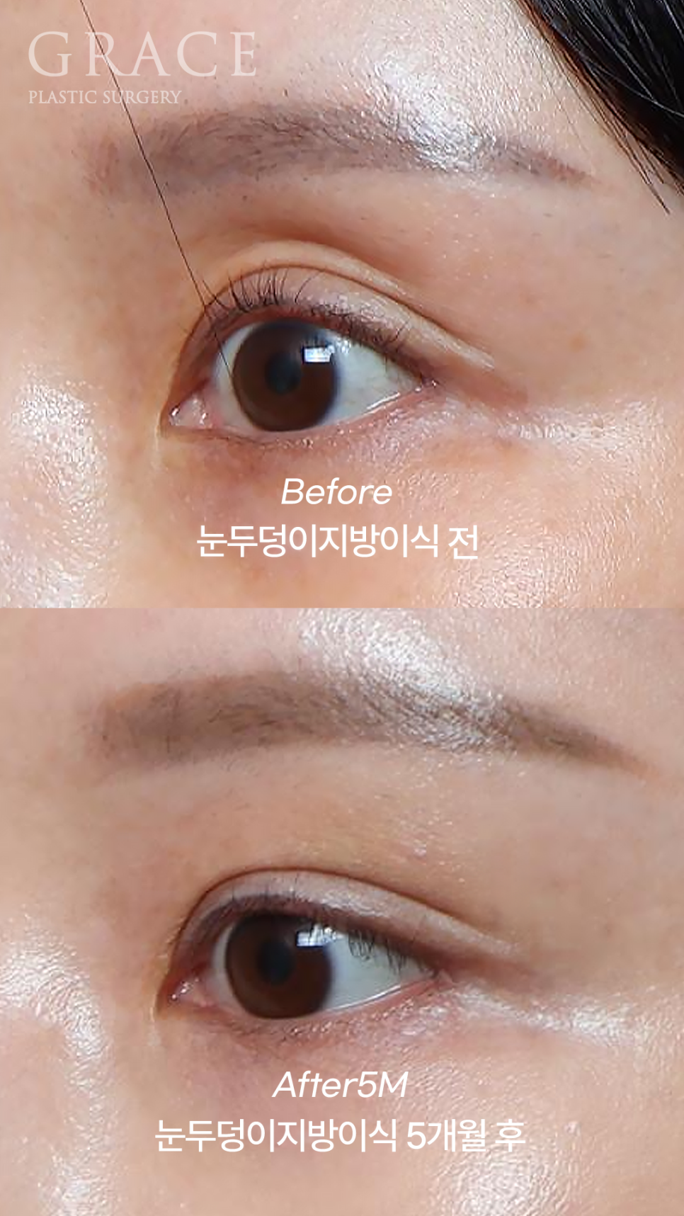 How to Fix a Sunken Eye Hollow: Upper Eyelid Fat Grafting + Ptosis Correction image 5