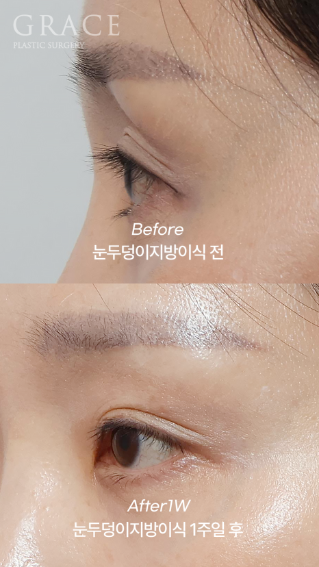 Sunken Upper Eyelids? With Just 0.9cc of Injection for Eye Hollow Fat Grafting image 5