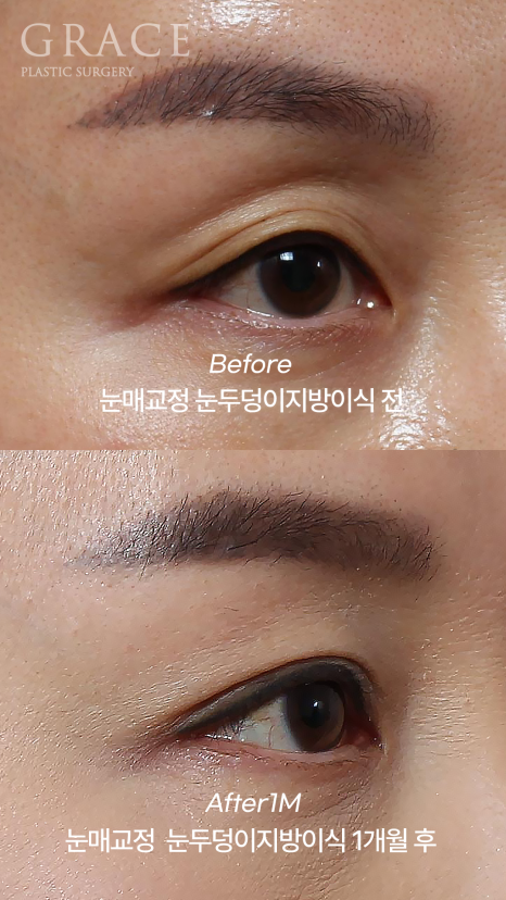 눈두덩이 지방이식 비절개 눈매교정 반드시 필요할까? (초이칼럼) 관련 이미지 3