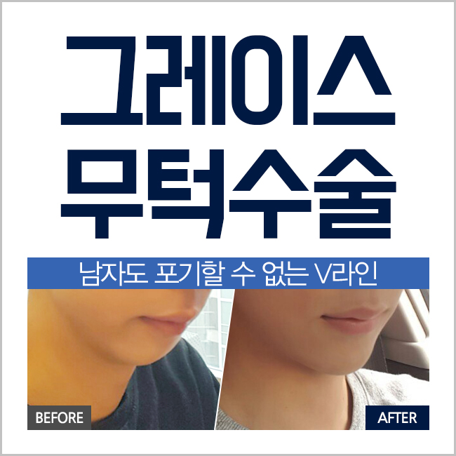 돌출입교정전후, 신사역 그레이스성형외과 무턱수술 관련 이미지 4