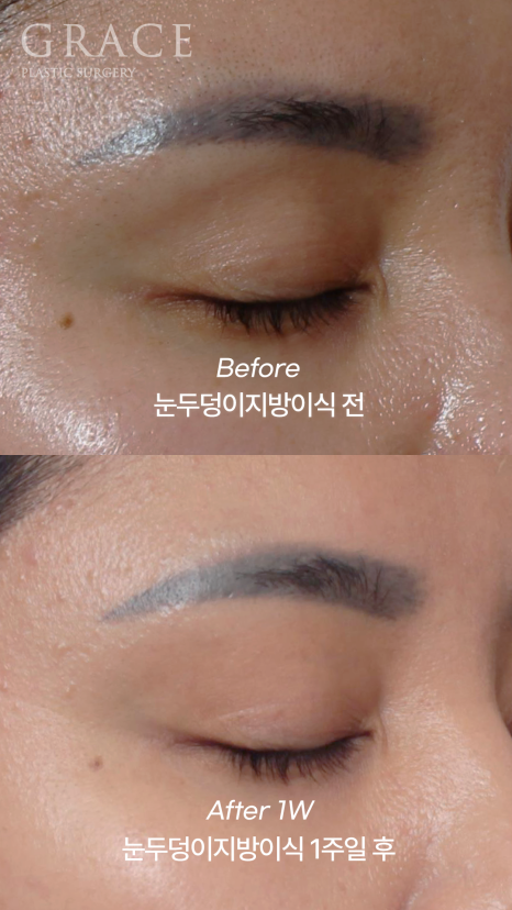 Before and After: Eyelid Fat Grafting Maintained for Over 2 Years in My Late 30s image 4