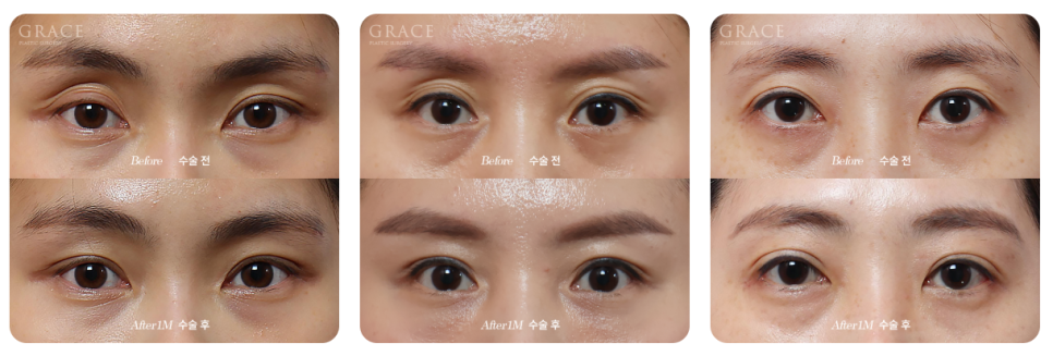 Are You Repeatedly Getting Fillers for Sunken Eye Hollows? Why Upper-Eyelid Fat Grafting May Be Needed image 1