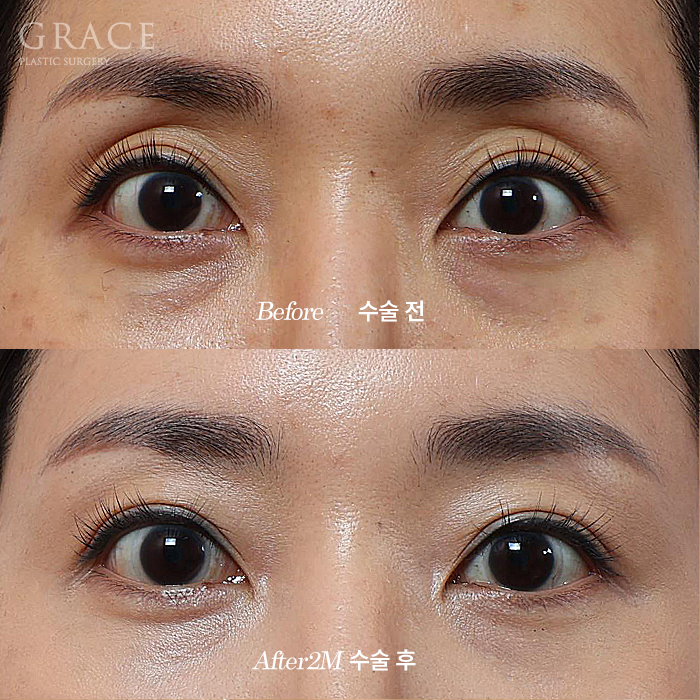 Is a Second Eyelid Fat Grafting Necessary? Are Frozen Fat Grafts a Side Effect? image 1