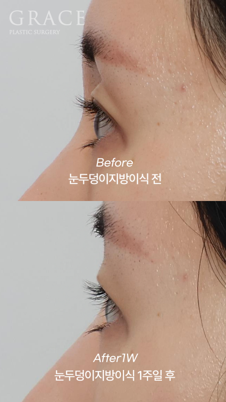 눈 감았을 때 울퉁불퉁? 실제 눈두덩이지방이식 전후 관련 이미지 11