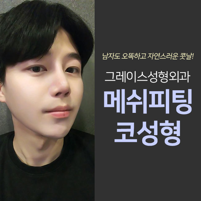 메쉬코성형 자연스러움과 오똑함을 동시에! 관련 이미지 4