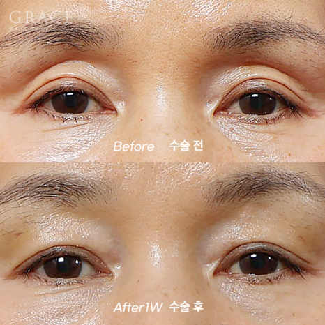 In Your 50s, Restoring a Youthful Look with Before-and-After Eye Surgery and Fat Grafting to the Upper Eyelids, Temples, Under-Eyes, and Above the Brows image 7