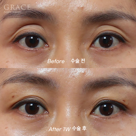 Sagging Eye Hollows and Sunken Eyelid Fat Grafting: Reasonable Cost (Price) Information and image 1