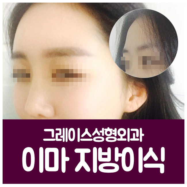 어느 각도에서도 예쁜 볼륨감! 이마지방이식 관련 이미지 1