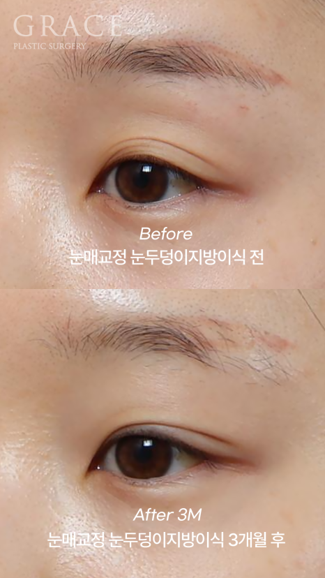 30대 눈꺼풀 꺼짐 교정 눈두덩이지방이식과 비절개눈매교정으로 자연스럽게 복원된 눈매 관련 이미지 2