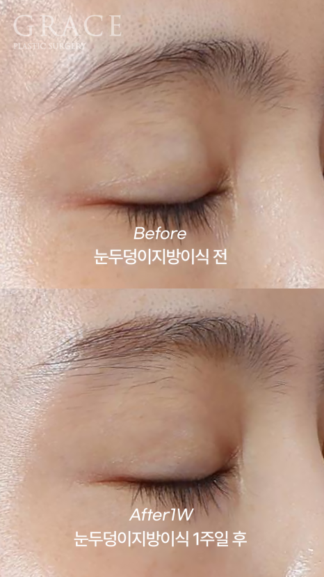 눈두덩이지방이식 30대 초반 전후 가격·부작용·후기까지 관련 이미지 3
