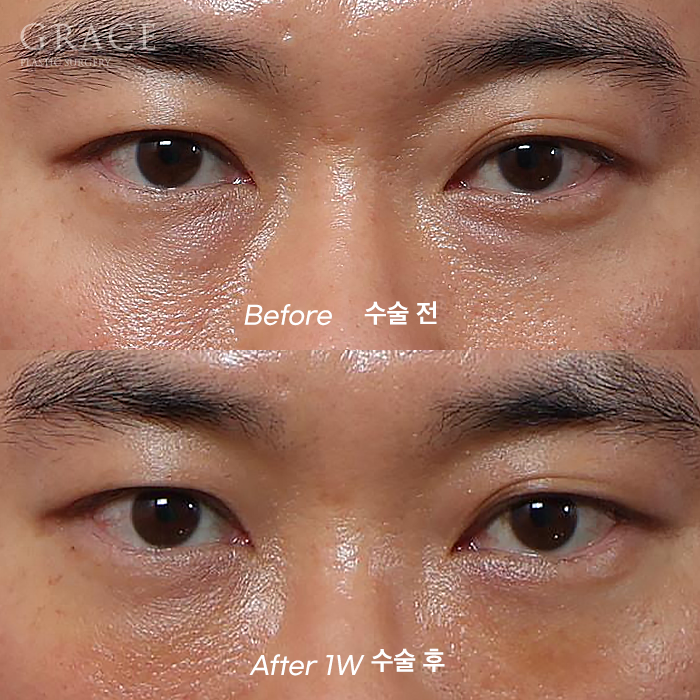 눈두덩이 지방이식 vs 눈밑지방재배치 (40대 중반 남자자&middot;비용&middot;붓기) 관련 이미지 1