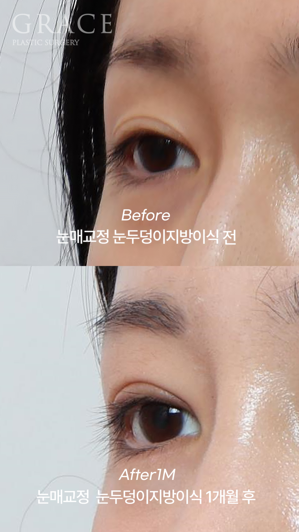 20대 후반 절개눈매교정+눈꺼풀지방이식 관련 이미지 3