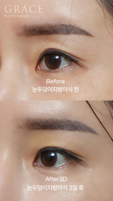 눈두덩이 지방이식 다운타임? 3일 후 흉터&middot;멍&middot;붓기 보여드립니다. 관련 이미지 2