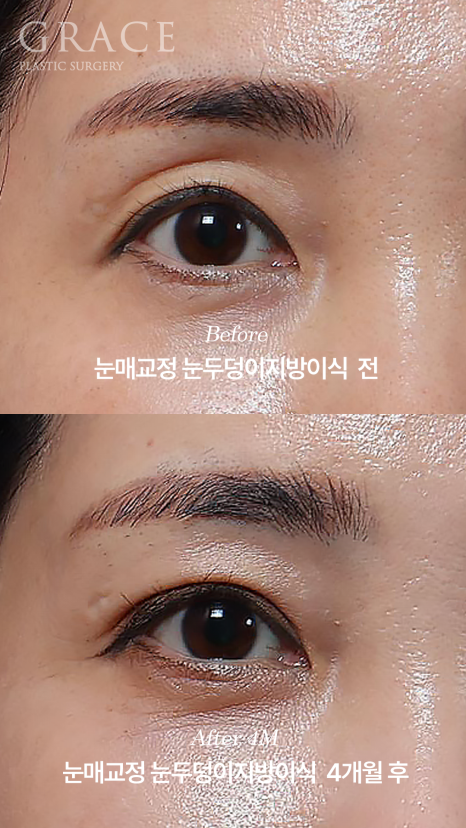 눈두덩이지방이식 11개월 후 부작용 없이 유지되는 변화 관련 이미지 7