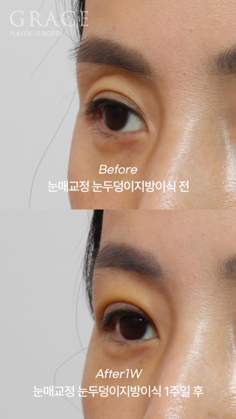 Eye Fat Grafting Instead of Eyelid Filler: Eye Shape Correction (1-Week Swelling Level) image 3