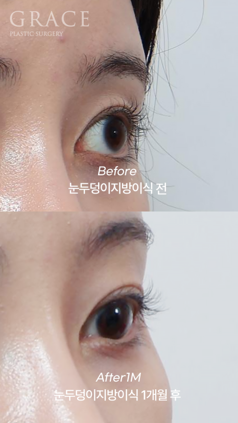 For Those Saddened by Sunken Eyelids (Upper-Eyelid Fat Grafting) image 7