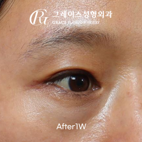꺼진 눈 성형 1주일 붓기 보정 없이 솔직하게 보여드립니다 관련 이미지 3