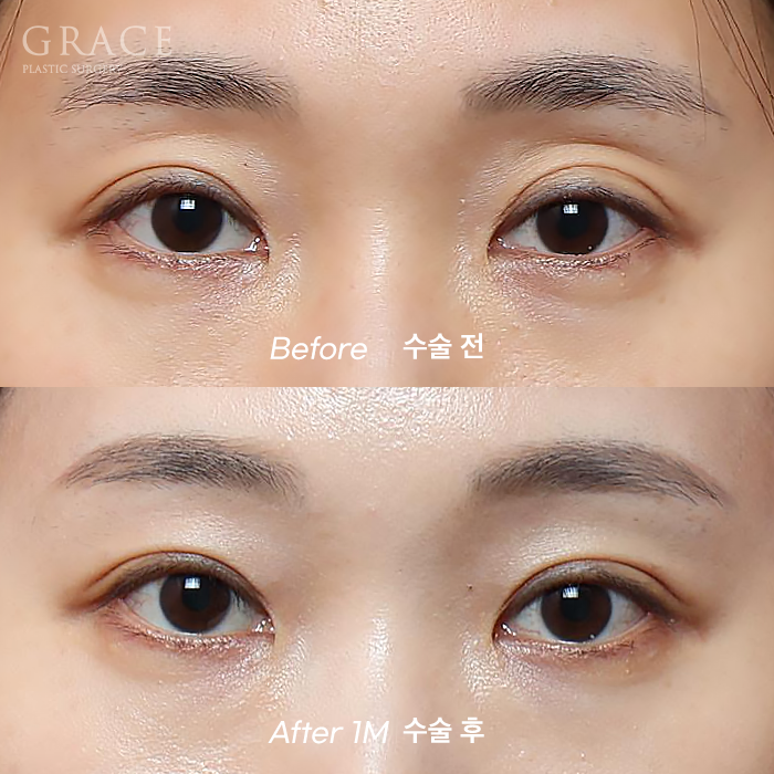 Male Brow Filler? Improvement with Eye-Hole Fat Grafting (Without Worrying About Side Effects, Scars, or Swelling) image 11
