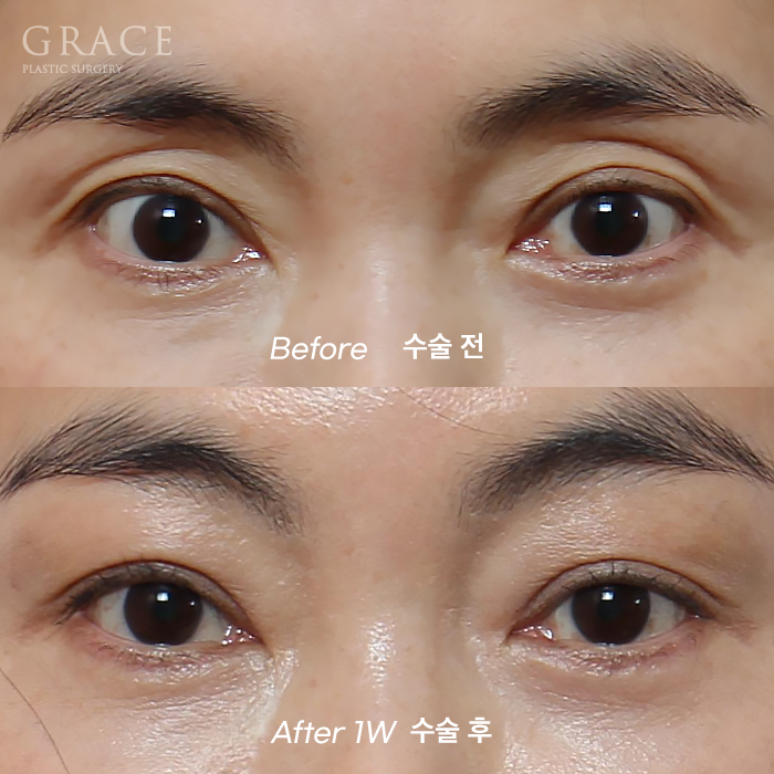 …The Result of Eyelid Fat Grafting (If You’re Worried About Side Effects and Swelling) image 8