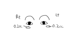 눈두덩이 지방이식 vs 눈밑지방재배치 (40대 중반 남자자&middot;비용&middot;붓기) 관련 이미지 5