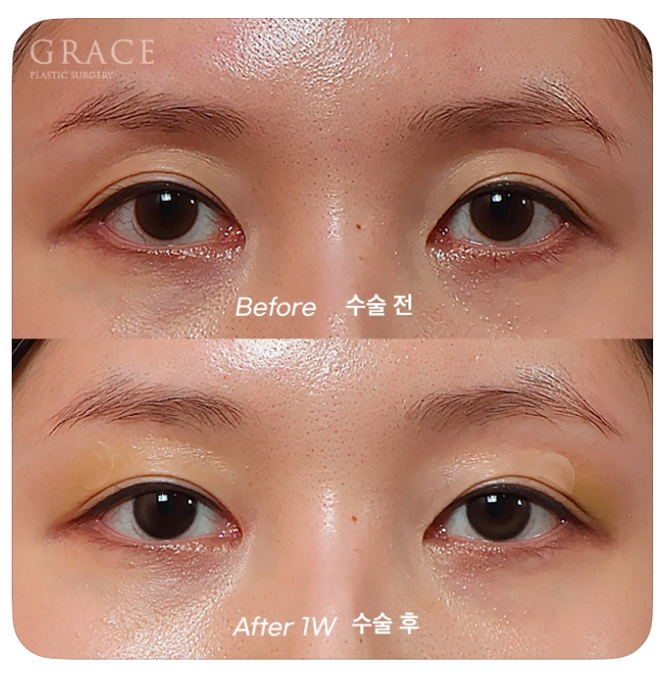 Causes of Sunken Eyelids and How Eyelid Fat Grafting Can Change Your Impression image 1