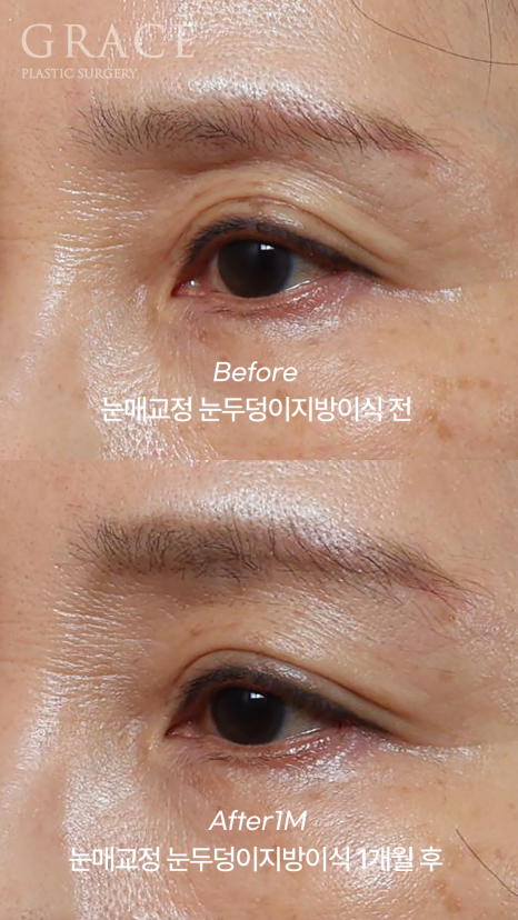Is Upper Blepharoplasty Necessary at 58? Swelling Side Effects After Non-Incisional Ptosis Correction and Upper Eyelid Fat Grafting image 4