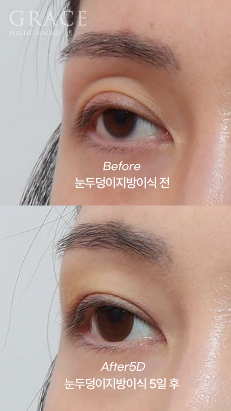 Eyelid Fat Grafting Bruising and Swelling Side Effects (Natural Eyelid Line After 5 Days) image 4
