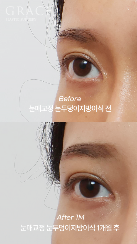 겹쌍꺼풀&middot;비대칭 눈 교정｜패인눈 함몰은 눈꺼풀 지방이식 관련 이미지 3