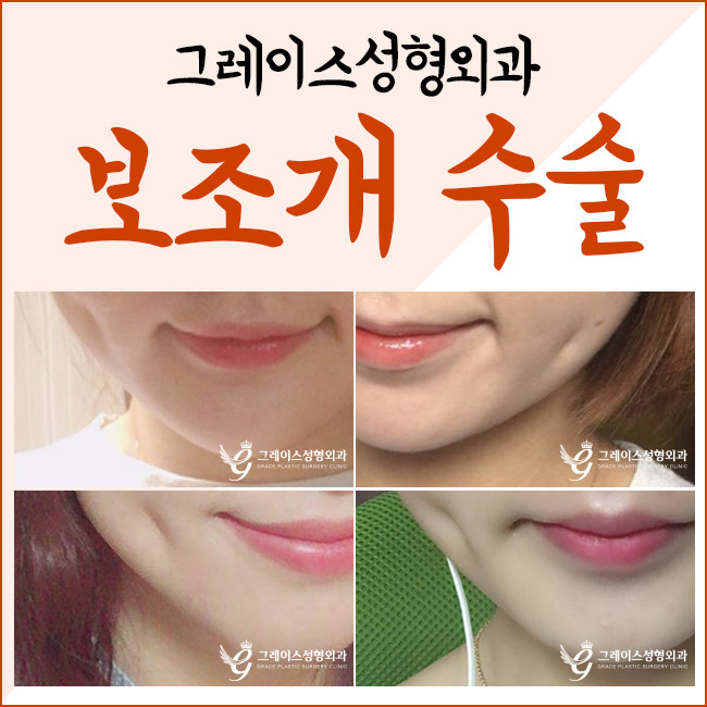 만족스러운 결과♡ 보조개수술후기를 알아본다면 관련 이미지 4