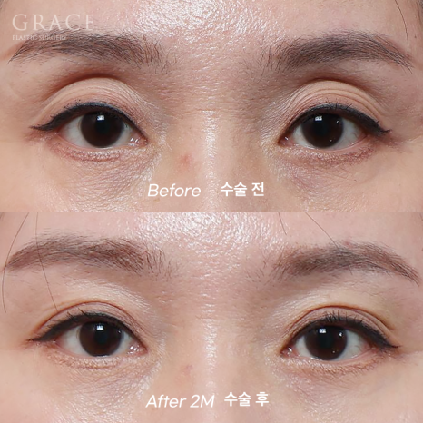 Why Choose Upper Eyelid Fat Grafting Instead of Eye-Hollow Filler? image 11