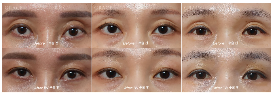 Why Eyelid Hollow Fat Grafting and Orbital Fat Injection Are Important: From Duration of Results to How to Prevent Bumpy Side Effects image 2