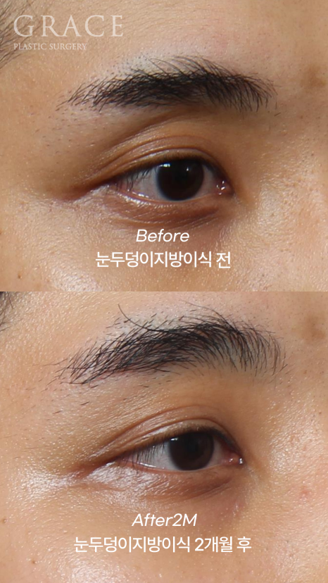 When the Eye Hollows Sink In, You Look Tired: Swelling After Fat Grafting for Men’s Eyes image 1