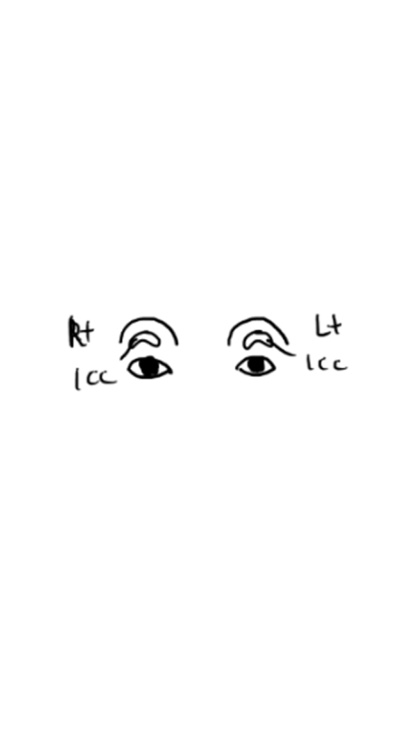 눈꺼풀 지방이식 보법이 다른 최문섭 원장님 실력 관련 이미지 10