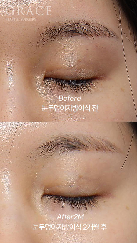 Upper Eyelid Fat Grafting That Shows When You Close Your Eyes? The Cause of Side Effects Is Different image 4