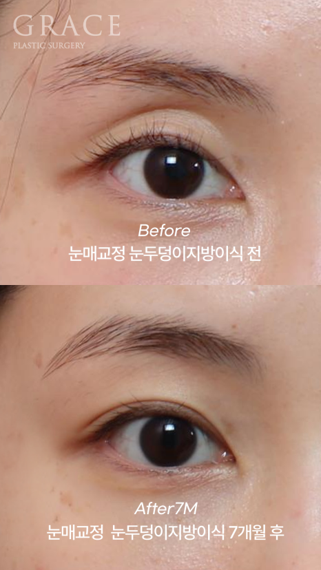 [20대 후반 눈꺼풀 지방이식+눈매교정]  7개월 후 유지력 이렇게 좋을 일? 관련 이미지 2