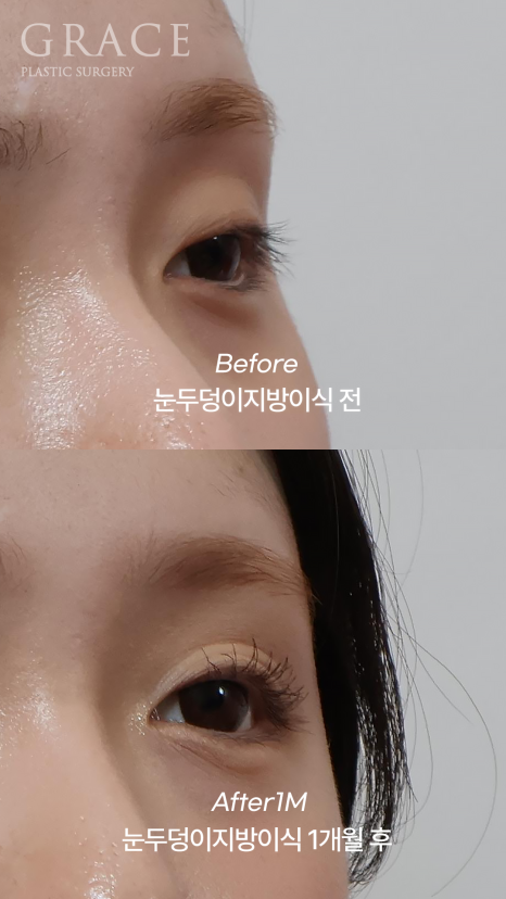 In Your Mid-20s, If You Have Ptosis Before and After Upper Eyelid Fat Grafting, Is Eye Correction Essential? image 8