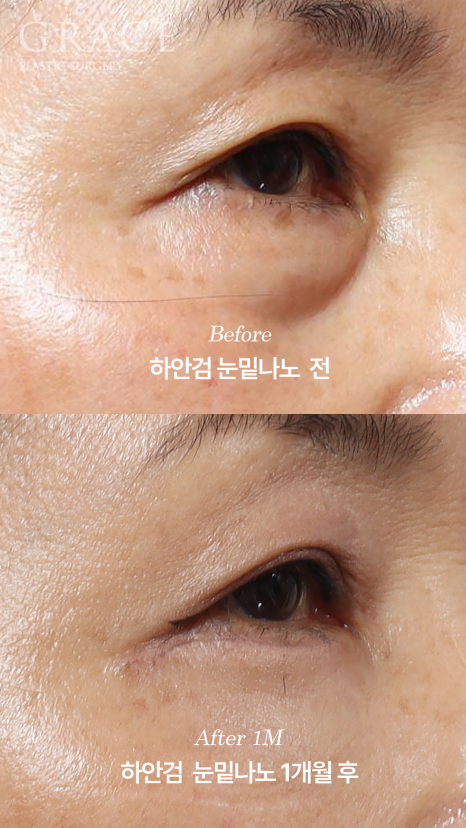 Side Effects of Under-Eye Fat Repositioning? Common Traits of People Who Say It Went Wrong image 3