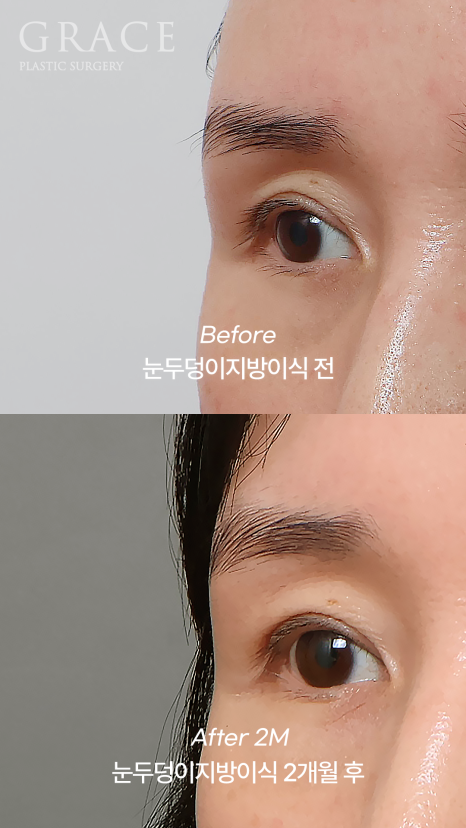 Why Do Hollow Eyelids Occur, and How Can They Be Naturally Improved? (Research Notes from a Doctor Performing Eyelid Fat Grafting) image 3