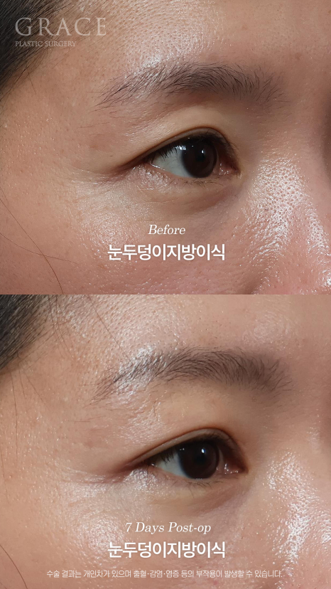 눈두덩이 지방이식 같은 내 지방인데 왜 울퉁불퉁해질까? 지방의 크기부터 다르니깐 관련 이미지 5