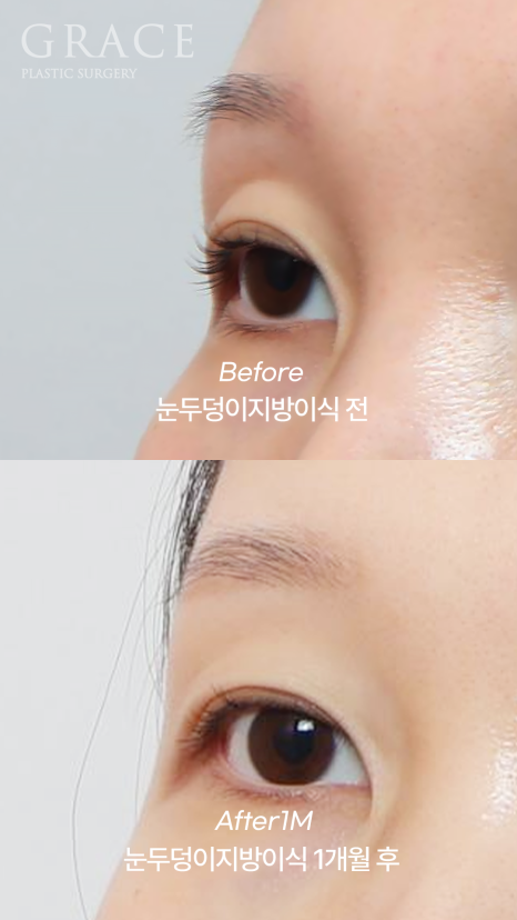 아이홀 꺼짐? 필러 말고 눈꺼풀 지방이식으로 해결했어요 (지방뭉침 없이) 관련 이미지 7